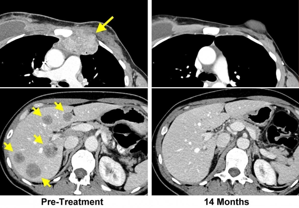 MRI of breast